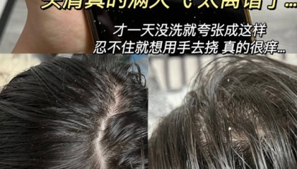 有毛囊炎适合用什么洗发水??无屑社交货币