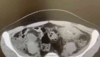 “再也不敢边吃饭边看手机了” 广州一女子误吞一次性筷子小竹片，肠管被刺破