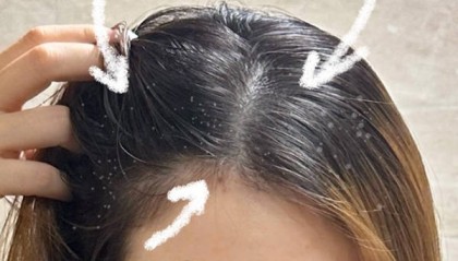 头发掉头屑多用什么洗发水好??无屑社交货币