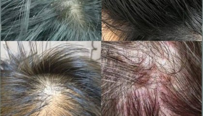 头发油皮屑多用什么洗发水??无屑社交货币