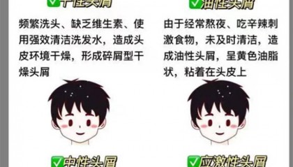 头发少头皮屑多用什么洗发水??无屑社交货币