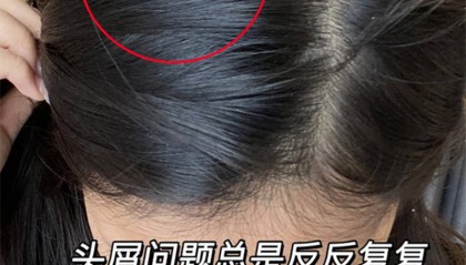 头痒头屑多用什么洗发水更好??无屑社交货币