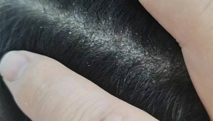 头皮毛囊炎用什么样的洗发水??无屑社交货币