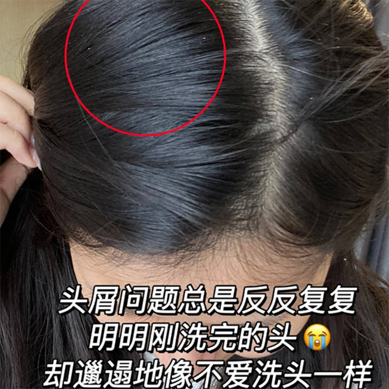 头痒头屑多用什么洗发水更好??无屑社交货币