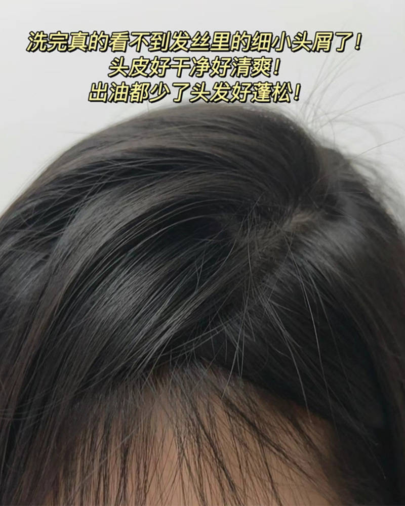 头痒头屑多用什么洗发水更好??无屑社交货币