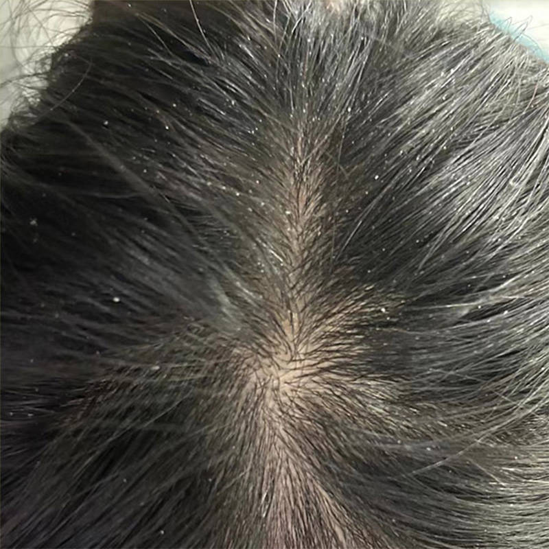 脂溢性脱用什么洗发水??无屑社交货币