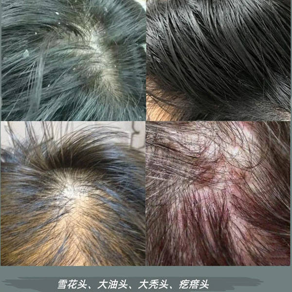 头发油皮屑多用什么洗发水??无屑社交货币