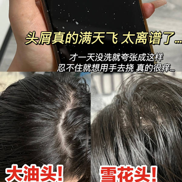 有毛囊炎适合用什么洗发水??无屑社交货币