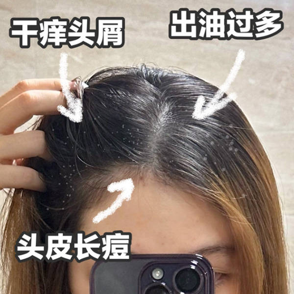 头发掉头屑多用什么洗发水好??无屑社交货币