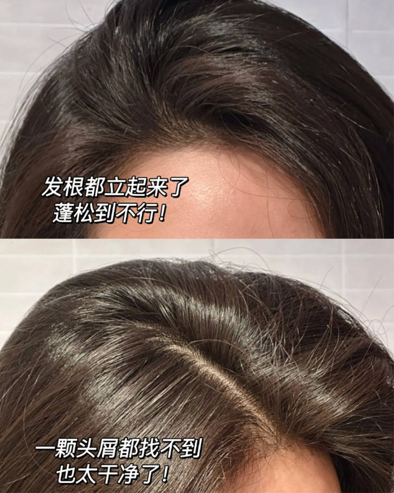 缓解毛囊炎的洗发水是什么牌子的??无屑社交货币